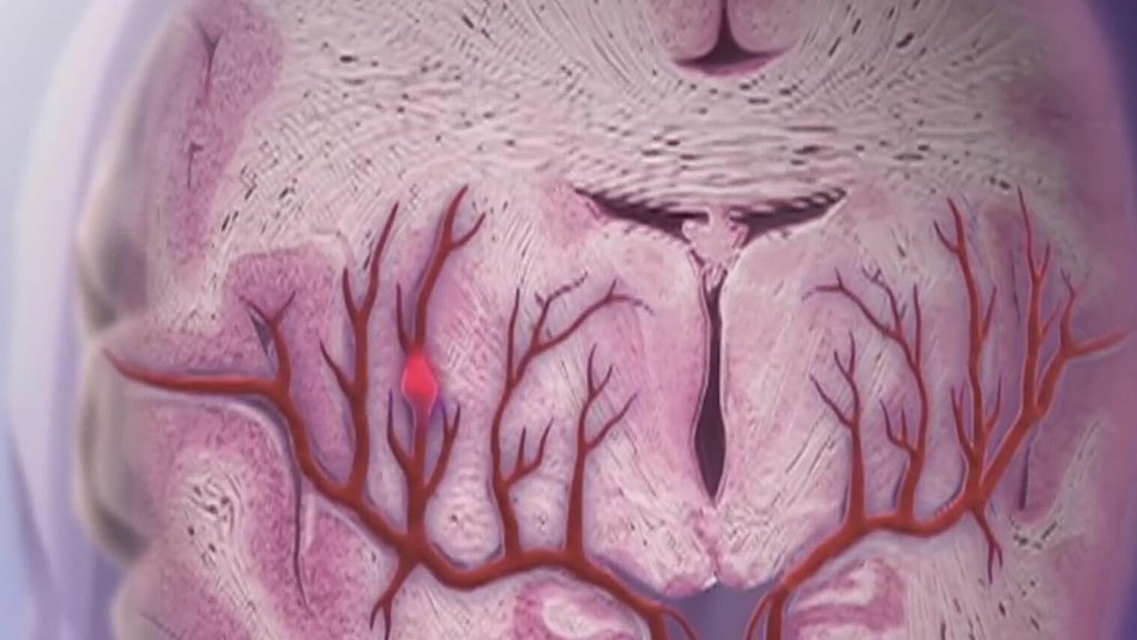 Knowing the signs of a stroke can save lives — Conyers Community news